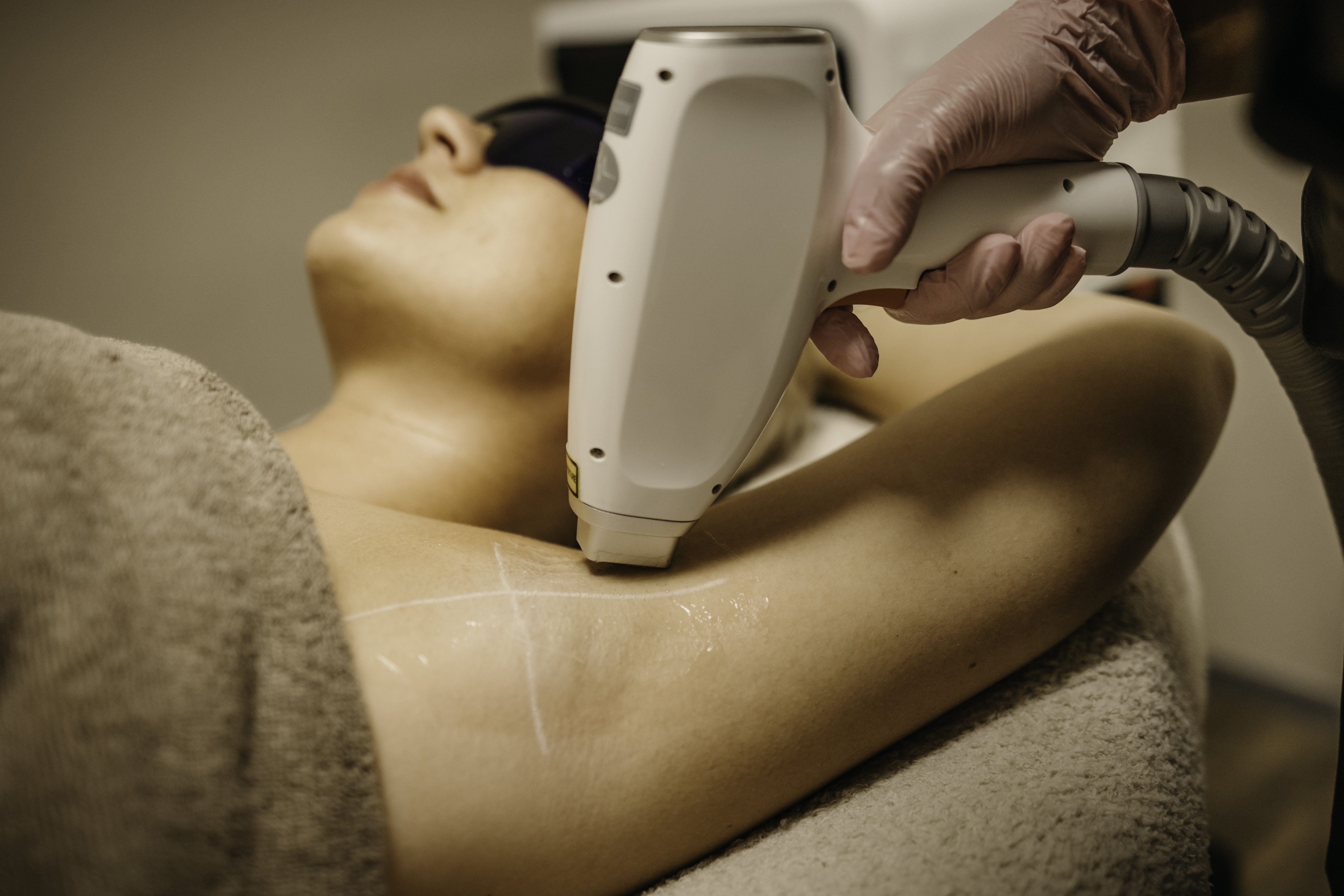 Laser ontharing Glowtique